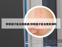 转移因子能治银屑病 转移因子能治银屑病吗