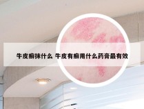 牛皮癣抹什么 牛皮有癣用什么药膏最有效
