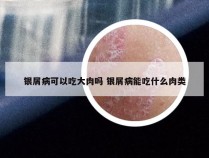 银屑病可以吃大肉吗 银屑病能吃什么肉类