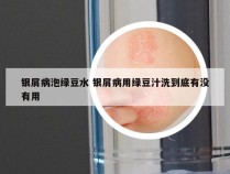 银屑病泡绿豆水 银屑病用绿豆汁洗到底有没有用
