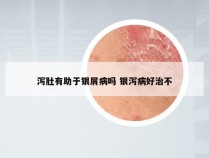 泻肚有助于银屑病吗 银泻病好治不
