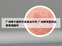 广州哪个医院牛皮癣治疗好 广州哪家医院治银屑病最好