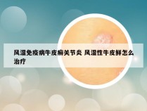 风湿免疫病牛皮癣关节炎 风湿性牛皮鲜怎么治疗