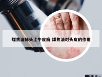 煤焦油抹头上牛皮癣 煤焦油对头皮的作用