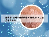 维生素C会对牛皮癣改善么 维生素c可以治疗牛皮癣吗