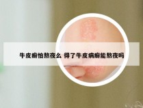 牛皮癣怕熬夜么 得了牛皮病癣能熬夜吗