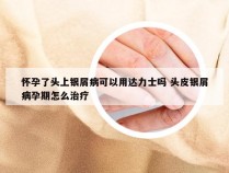 怀孕了头上银屑病可以用达力士吗 头皮银屑病孕期怎么治疗