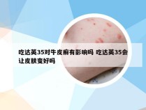 吃达英35对牛皮癣有影响吗 吃达英35会让皮肤变好吗