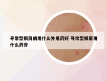 寻常型银屑病用什么外用药好 寻常型银屑用什么药膏