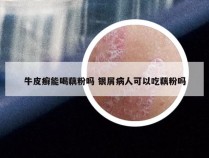 牛皮癣能喝藕粉吗 银屑病人可以吃藕粉吗