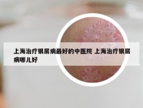 上海治疗银屑病最好的中医院 上海治疗银屑病哪儿好