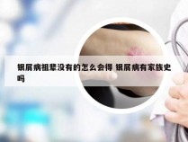 银屑病祖辈没有的怎么会得 银屑病有家族史吗