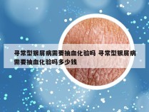 寻常型银屑病需要抽血化验吗 寻常型银屑病需要抽血化验吗多少钱