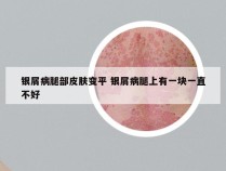 银屑病腿部皮肤变平 银屑病腿上有一块一直不好