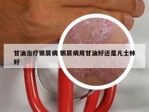 甘油治疗银屑病 银屑病用甘油好还是凡士林好