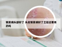 银屑病头部好了 头皮银屑病好了之后还要用药吗