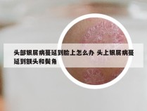 头部银屑病蔓延到脸上怎么办 头上银屑病蔓延到额头和鬓角