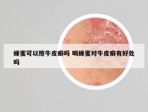 蜂蜜可以擦牛皮癣吗 喝蜂蜜对牛皮癣有好处吗