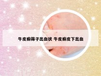 牛皮癣筛子出血状 牛皮癣皮下出血