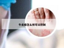 牛皮癣怎么样可以控制