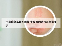 牛皮癣怎么做不遗传 牛皮癣的遗传几率是多少