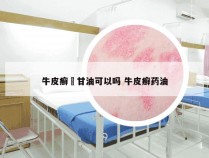牛皮癣抺甘油可以吗 牛皮癣药油