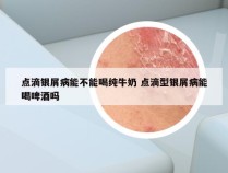 点滴银屑病能不能喝纯牛奶 点滴型银屑病能喝啤酒吗