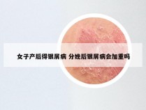 女子产后得银屑病 分娩后银屑病会加重吗