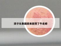 孩子从泰国回来就得了牛皮癣