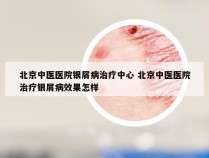 北京中医医院银屑病治疗中心 北京中医医院治疗银屑病效果怎样