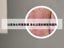 过度角化吗银屑病 角化过度的鳞屑斑图片