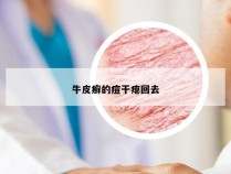 牛皮癣的痘干瘪回去