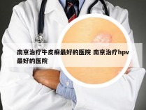 南京治疗牛皮癣最好的医院 南京治疗hpv最好的医院