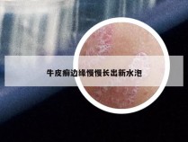 牛皮癣边缘慢慢长出新水泡