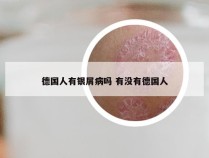德国人有银屑病吗 有没有德国人