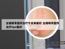 全国那家医院治疗牛皮癣最好 全国哪家医院治疗hpv最好
