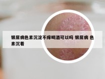 银屑病色素沉淀不痒喝酒可以吗 银屑病 色素沉着