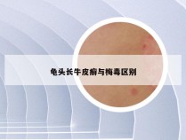 龟头长牛皮癣与梅毒区别