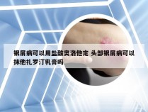 银屑病可以用盐酸奥洛他定 头部银屑病可以抹他扎罗汀乳膏吗