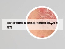 幽门螺旋银屑病 银染幽门螺旋杆菌hp什么意思