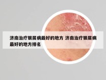 济南治疗银屑病最好的地方 济南治疗银屑病最好的地方排名