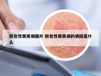 脓包性银屑病图片 脓包性银屑病的病因是什么