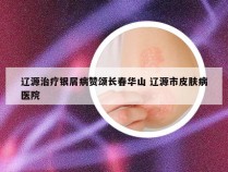 辽源治疗银屑病赞颂长春华山 辽源市皮肤病医院