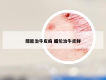 醋能治牛皮癣 醋能治牛皮鲜