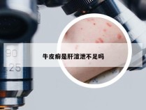 牛皮癣是肝渲泄不足吗