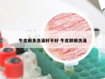牛皮癣多洗澡好不好 牛皮肤癣洗澡
