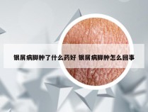 银屑病脚肿了什么药好 银屑病脚肿怎么回事