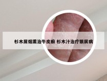 杉木屑烟熏治牛皮癣 杉木汁治疗银屑病