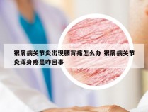 银屑病关节炎出现腰背痛怎么办 银屑病关节炎浑身疼是咋回事