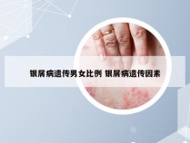 银屑病遗传男女比例 银屑病遗传因素